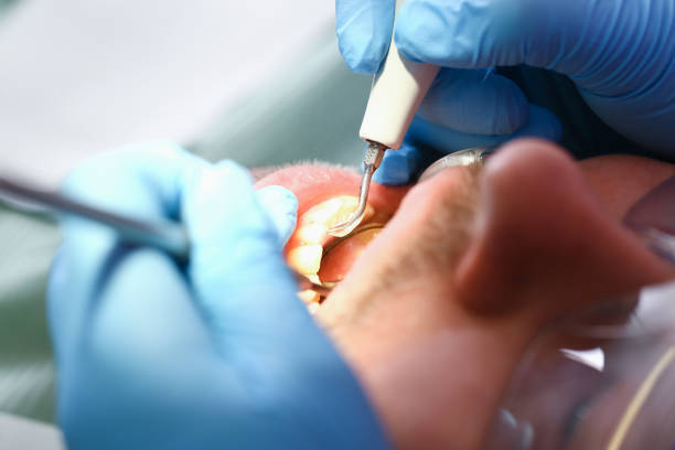 Best Emergency Root Canal Treatment in Rosharon, TX